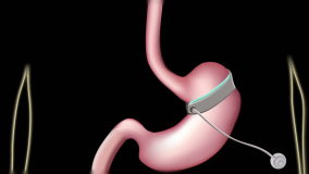 Gastric Band Surgery